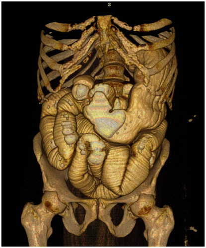 Figure 9b: 3D reconstruction of CT enterography showing marked SBO. Manipulation on the workstation allows accurate evaluation of the transition point