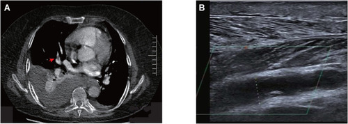 Figure 1 (A) Computed tomography pulmonary angiography (CTPA) revealed acute bilateral PE, bilateral pleural effusion with partial dilatation of the lower lobes and multiple discrete pulmonary nodules. (B) Doppler ultrasound examination detected evidence of deep vein thrombosis (DVT) in the right posterior tibial vein. The right posterior tibial vein was dilated, about 10.6 mm at the deepest point, with hypoechoic filling.