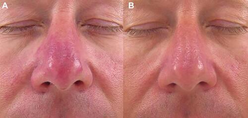 Figure 4 Before (A) and after (B) IPL treatment of red nose rosacea with Lumenis One (20 J/cm2, 3.5–3.5 msec). Figure courtesy of Dr. Goldman.