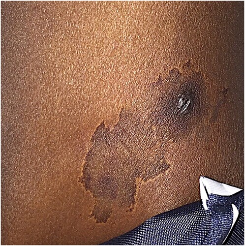 Figure 1. Skin manifestation of a 30-year-old African American male that presented with lesion on upper extremity and hemolytic anemia.
