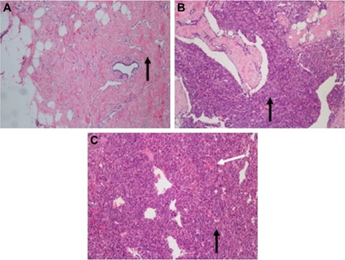 Figure 4 Hematoxylin–eosin-stained sections of primary angiosarcoma of breast (magnification ×100).