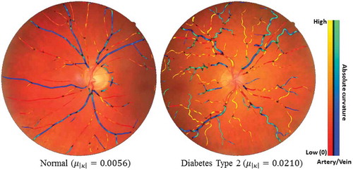 Figure 14. Two typical examples of showing the tortuosity (mean curvature) difference between one healthy subject and one diabetes type 2 subject. Blue indicates veins and red indicates arteries.