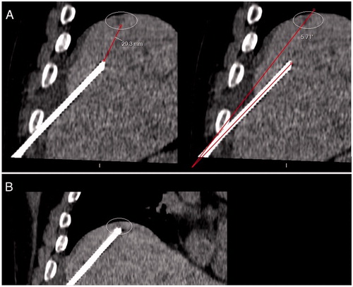 Figure 3. First-pass control CT (coronal reconstruction) acquired after applicator insertion using EMN system and HFJV, for a 4-mm liver metastasis located on the dome, in a 73-year-old man with colon cancer. The needle path was considered adequate to reach the target, with an angle between the needle trajectory and the line connecting the entry point and the center of the lesion of 5.7 degrees; the tip-to-tumor distance was 29 mm A. The probe was then advanced accordingly on EMN. A second control CT showed that the target had been reached B. EMN: electromagnetic navigation; HFJV: high-frequency jet-ventilation; CT: Computed Tomography.