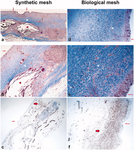 Figure 1. Examples of biopsies. Masson trichrome staining, original magnification 40x (a,d); 100x (b,e); α-smooth muscle actin, original magnification 40x (c,f). (A–C) illustrates a type A reaction and d-f a type B reaction. Small arrow: synovial metaplasia. Arrow head: mesh fibers. Asterix: collagen fibers. Thick arrow: actine positive myofibroblasts.