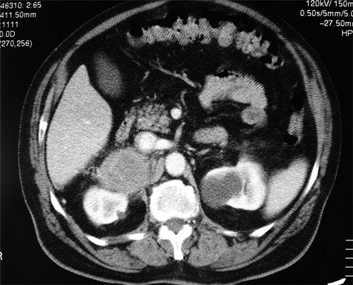 Figure 2 Abdominal computed tomography shows a 10-cm right adrenal lesion.