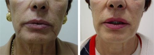 Figure 5 Before (left) and one month after (right) the treatment of perioral wrinkles (marionette lines and oral commissures) with 2 mL of crosslinked CMC.