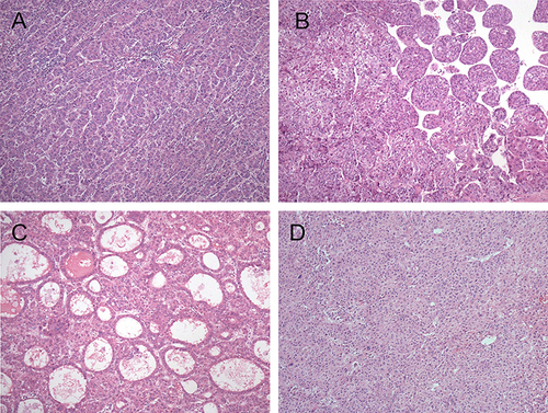Figure 3 HCC with metabolic risk factor architectural growth patterns: (A) The tumor cells grow in trabecular pattern. (B) The tumor cells grow in a macrotrabecular pattern with thick trabeculae more than 10 cell layers. (C) The tumor cells grow in a pseudoglandular pattern with glandular or acinar structure. (D) The tumor cells grow in a solid pattern without trabecular or pseudoglandular growth. (hematoxylin and eosin stain, original magnification ×100).
