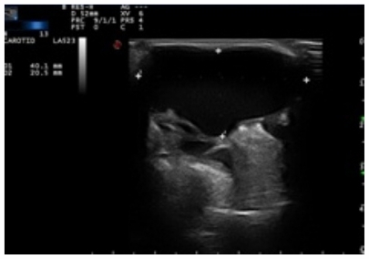 Figure 2 The aneurysm is seen in Doppler ultrasonography. suture using 4-0 prolene.