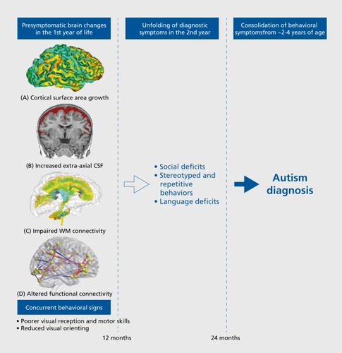 Figure 1. Several brain features have been identified during the presymptomatic period in autism—before the unfolding of the diagnostic symptoms of autism. (A) Cortical surface area growth between 6 and 1 2 months of age is predictive of an eventual autism diagnosis35; (B) Increased volume of extra-axial CSF at 6 months of age (ie, CSF in the subarachnoid space; colored in red) is associated with autism diagnosis, early motor deficits, and later autism severityCitation34,Citation38; (A) Aberrant white matter connectivity (fractional anisotropy in the genu of the corpus callosum) is present at 6 months of age and is predictive of the severity of repetitive behaviors and sensory responsiveness at the time of diagnosisCitation50-Citation52; (DD) Altered functional connectivity at 6 months of age predicts an eventual autism diagnosis.Citation55 These neural features are concurrent with early behavioral signs in the first year of life, followed by the unfolding of diagnostic symptoms in the second year of life, and the consolidation of behavioral symptoms that are fully diagnostic of autism. CSF, cerebrospinal fluid; WM, white matter.
