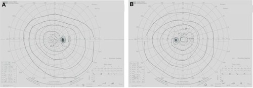 Figure 2 Right (A) and left (B) Goldmann perimetry showed constriction of the I/2 e isopter in both eyes.