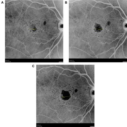 Figure 1 Infrared autofluorescence fundus photograph of age-related geographic atrophy at presentation (A), at the time of initial panmacular SDM treatment 7 months later (B), and at the last visit 34 months following initiation of panmacular SDM treatment (C).