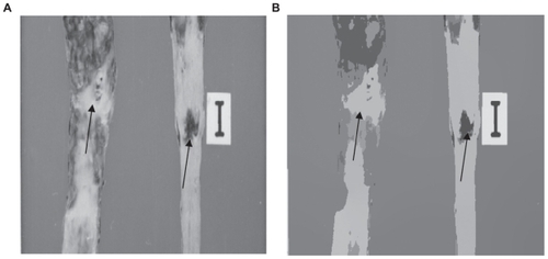 Figure 3 (A) Original image. (B) Segmentation by using our unsupervised strategy. The arrows indicate the isolated lesions. Note the quality of segmentation of the Type lesion in (B).