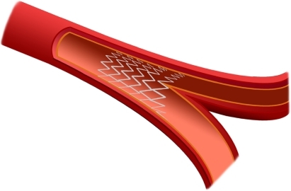 Figure 3 Representation of the self-expanding nickel-titanium Axxess stent in its definitive placement after deployment.