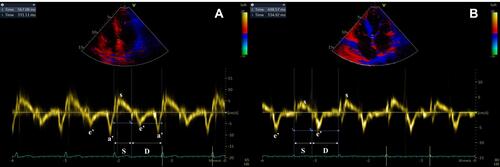 Figure 2 The measurement of systolic and diastolic durations from pulsed tissue Doppler for (A) patients with sinus rhythm or (B) atrial fibrillation.