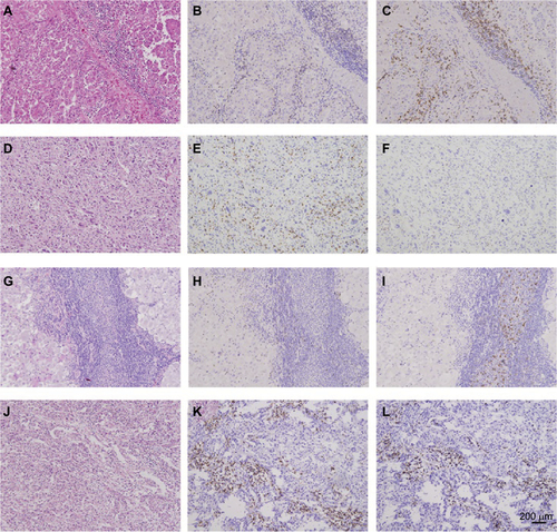 Figure S2 PD-1/CD8 expression in mRCC tissues.Notes: Hematoxylin-eosin staining (A), CD8 low (B), PD-1 high (C), hematoxylin-eosin staining (D), CD8 high (E), PD-1 low (F), hematoxylin-eosin staining (G), CD8 low (H), PD-1 low (I), hematoxylin-eosin staining (J), CD8 high (K), PD-1 high (L) in mRCC tissues. Original magnification: ×100.Abbreviations: PD-1, programmed cell death protein 1; mRCC, metastatic renal cell carcinoma.