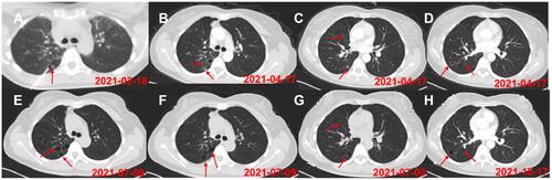 Figure 1 CT shows (A) the puncture position. (B–D) new lung cavities and metastases before treatment with anlotinib. (E–H) stabilization of lung lesions after anlotinib treatment. The red arrows in the figure indicate changes in lesions before and after treatment.