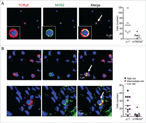 Figure 5. γδ Tcells infiltrating mouse and human melanoma are able to express NOS2. (A) Representative confocal microscopy images showing γδ T cells positive for NOS2 from cells derived from TdLNs of Ret mice and stained with antibodies to TCR γδ (red), NOS2 (green) and counterstained with DAPI (blue). Bars 10 µM. 40 X objective (left). Quantification of γδ T cells and γδ T cells positive for NOS2 from 500 to 1,500 cells (right). Experiments were performed five times. (B) Representative digital microscopy images of 7 µm sections from frozen biopsies of human primary melanoma (patient 14 and 12, respectively). Sections were stained with antibodies to TCR γδ (red) and NOS2 (green). Nuclei were counterstained with DAPI (blue). Bars 5 µM. 40 X objective (left). Quantification of γδ T cells and γδ T cells positive for NOS2 in 13 patients with detected γδ T cells (right). Patients were divided into three groups with low, intermediate or high risk of disease's relapse according to Breslow thickness. Arrows indicate NOS2-expressing γδ T cells.