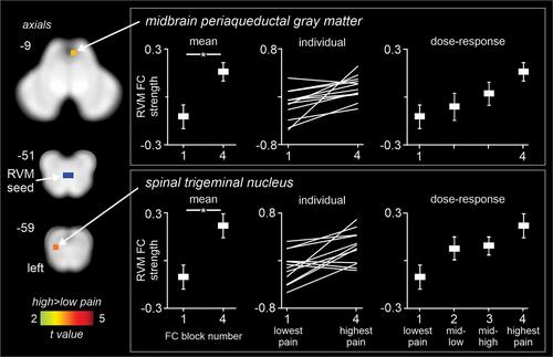 Figure 3 Significant differences in rostral ventromedial medulla (RVM) functional connectivity (FC) strength between periods of high versus low pain in 12 fluctuating pain subjects. The overlay on the left shows the RVM seed in blue and shows regions in which RVM FC strength was greater during high compared with low pain (hot color scale) overlaid onto axial slices of the SUIT template in the 12 fluctuating pain subjects. The slice locations in Montreal Neurological Institute space are shown at the top left of each slice. Note that RVM FC was greater during high pain in the region of the midbrain periaqueductal gray matter and the spinal trigeminal nucleus. The plots to the left show mean±SEM RVM FC strengths during lowest pain (block 1) and highest pain (block 4). The center plots show the 12 individual subject RVM FC values during lowest and highest pain blocks. Note that as pain increases, 11 of the 12 subjects display an increase in RVM FC strength with the periaqueductal gray and 9 subjects show similar increases in RVM FC strength with the spinal trigeminal nucleus. The dose-response plots to the right show mean±SEM RVM FC strengths during four blocks of increasing pain from lowest pain to highest pain. Note that as pain increases so does RVM FC strength. *Significant difference determined in the voxel-by-voxel analysis.