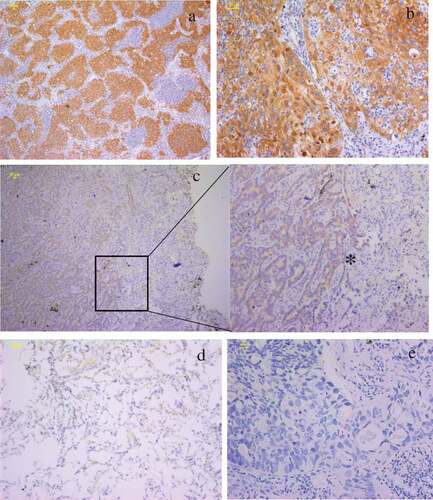 Figure 1. Immunolocalization of FAM136A in human lung carcinoma. a. strong immunoreactivity of FAM136A was widely detected in lung carcinoma b. FAM136A was immunolocalized mainly in the cytoplasm of lung carcinoma cells. c. FAM136A was positive in the in situ lesions of lung carcinoma, but not in the non-neoplastic mucosal epithelium adjacent to the carcinoma (*).d. FAM136A was weakly detected in non-neoplastic mucosal epithelium. e.Negative control for FAM136A immunohistochemistry. Scale bar: 20 μm