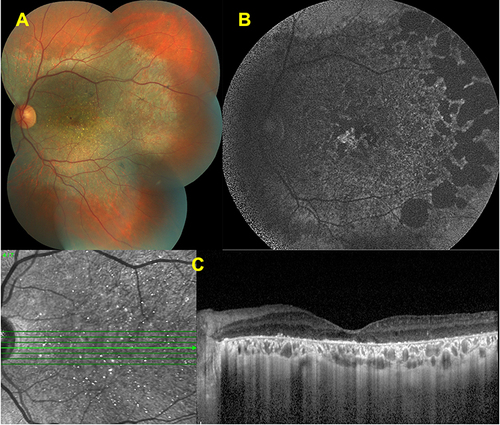 Figure 4 Features of intermediate disease stage. Color fundus image of a left eye (A) showing the chorioretinal atrophy extending from the posterior pole and glistening crystals at the macula. Fundus autofluorescence image (B) revealing the well-demarcated hypofluorescent patches corresponding to the atrophy. Spectral domain-optical coherence tomography (SD-OCT) section (C) demonstrating the hyperreflective deposits at the RPE – Bruch’s membrane complex, together with the disruption and loss of the EZ band.