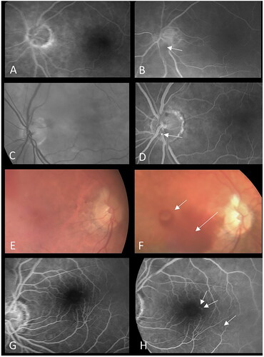 Figure 1. Ocular findings in retinal fluorescein angiography and fundus images before and after transcatheter aortic valve replacement. Notes: Ophthalmic changes were not detected in preoperative images (A, C, E, G). Postoperative retinal abnormalities included an optic disc hemorrhage (B), cholesterol plaque in the central retinal artery (D), retinal macroaneurysm with vitreous bleeding (F), and a leakage of microaneurysms in macular vasculature (H).