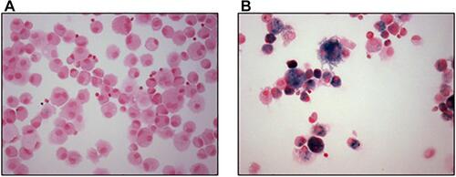 Figure 4 Siderophages in macrophages collected by bronchoalveolar lavage. Macrophages collected from nonsmoker (A) do not stain for iron (blue) while those from a smoker (B) do. Stain is Perls’ Prussian blue. Magnification approximates 400×.