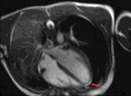 Figure 2. Cardiac MRI; arrow indicating an area of epicardial inflammation at the apex of the left ventricle.