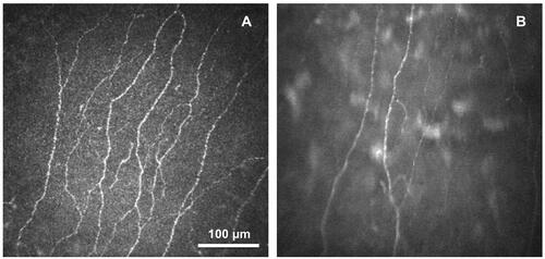Figure 2 Confocal images of corneal subbasal nerves obtained from 2 types of confocal microscope: (A) Laser scanning confocal microscope (LSCM) and (B) Slit-scanning confocal microscope (SSCM).