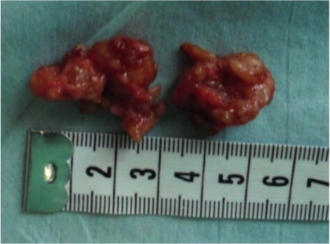 Fig. 3 A typical brownish-red appearance of a giant cell tumour.