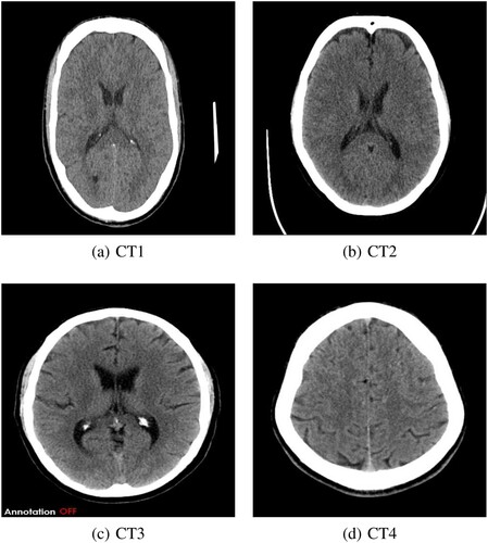 Figure 10. CT brain images: (a) CT1, (b) CT2, (c) CT3 and (d) CT4.