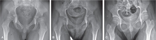 Figure 1. A. Preoperative radiograph of a 5 year 5-months-old boy with spastic quadriplegia (GMFCS level V), showing bilateral hip subluxation with migration percentage (MP) 40% (right hip) and 48% (left hip). B. 1.8 years after soft-tissue releases, showing good primary correction; MP of the left hip was reduced from 48% to 32%. C. 6.7 years postoperatively, showing good outcome with MP 15% (right hip) and 25% (left hip).