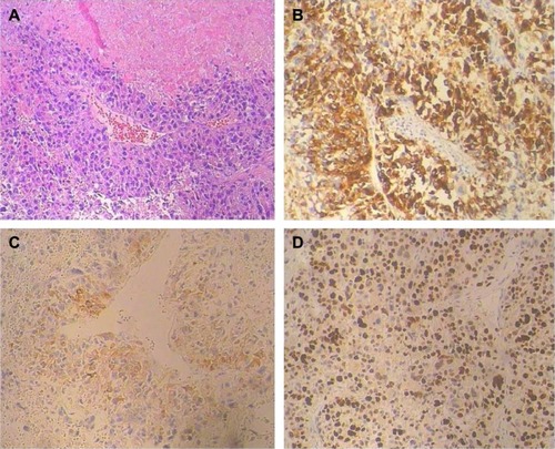 Figure 1 Pathological findings of the pulmonary metastases from malignant uterine PEComa.