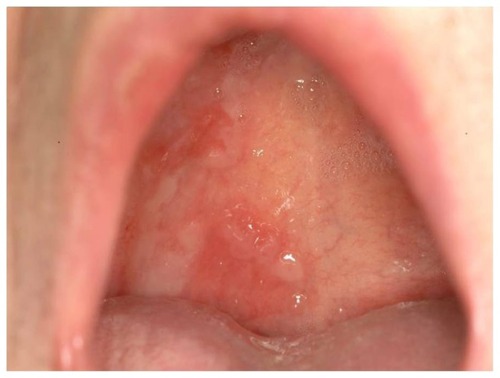 Figure 2 Hard-palate ulceration.