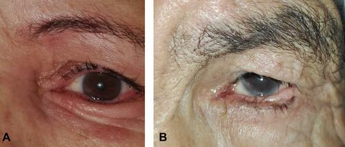 Figure 2 (A) Postoperative photograph of a patient with recurrent trichiasis and anterior lamellar laxity following ALR. (B) Postoperative photograph of another patient with recurrent trichiasis despite the lid margin in a good position following the same procedure.