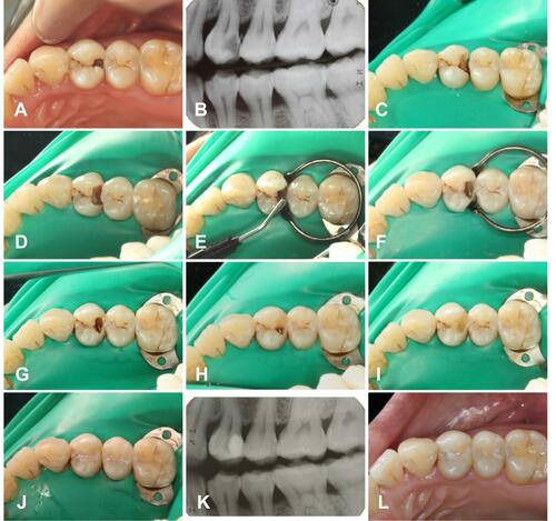 Figure 1 Steps of restoration in Tooth 24. (A) Preoperative image of 24; (B) Preoperative radiographic image of 24; (C) Removal of carious enamel and dentine; (D) Placement of glass ionomer cement liner; (E) Injection of flowable composite into the floor of the cavity; (F) Construction of the distal proximal wall; (G) Removal of the sectional matrix; (H) Filling the cavity using the incremental technique; (I) Reconstruction of the morphology of 24; (J) Sealing the micro-cavitated occlusal fissure caries with a fissure sealant; (K) Postoperative bitewing radiograph; (L) Postoperative image taken three months after the restoration.