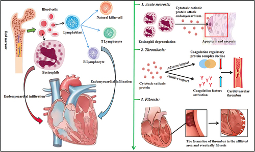 Figure 1 The staging of Loeffler endocarditis. Endomyocardial infiltration with myeloid eosinophils and lymphocytes. 1st Stage of Acute Necrosis stage; 2nd Stage of thrombosis stage; 3rd Stage of fibrosis stage.
