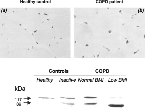 Figure 6 Skeletal muscle apoptosis in COPD. Source: (Citation[51]), Fig. 2, p. 487. Top panel: representative example of a muscle biopsy obtained in a control subject (a) and in a patient with COPD and low BMI (b). Nuclei are stained blue in the former (non-apoptotic), whereas most of them are stained brown (apoptotic) in the latter. Bottom panel: Western blot showing the relative intensities of the two poly(ADP-ribose) polymerase (PARP, a marker of cellular apoptosis) bands (89- and 117-kD fragments) in a representative subject of each of the 4 groups studied.