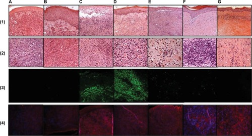 Figure 2 Time course of histological and immunohistochemical changes in cutaneous melanoma metastases after ECT. Column (A) before treatment; (B) 10 min; (C) 3 h; (D) 3 days; (E) 10 days; (F) 1 month; (G) 2 months. Lines: 1 and 2: H&E; Line 3: TUNEL reaction; Line 4: caspase-3 staining. Line 1 original magnification 100×; Line 2 original magnification 250×.