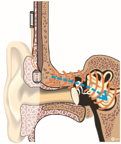 Figure 6 The bone conduction implant is positioned externally on the skin behind the ear similar to conventional bone conduction devices that are driven through the skin.