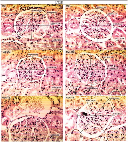 Figure 6. H & E stained kidney histopathology micrographs of STZ group of rats before and after treatment with CSE, metformin and aspirin (×400). LT2D led to a widening of urinary space, overlaying cellular crescent fibrinohyalinosis, dilatation, vascularization, and necrosis and leukocyte infiltration. Treatment of STZ group with chicory may have improving effects. Aspirin apparently did not improve the structural situation; more dilatation and vascularization was observed, urinary space was still large and hyalinization was present.