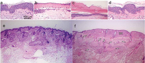 Figure 3. H&E histology of the changes in facial skin following NPS treatment using an energy setting of 500 mJ/mm3 with a 1.5 × 1.5 mm applicator. (a) Untreated facial skin biopsy from patient 5; (b) biopsy of facial skin from patient 5 one day after NPS treatment. Ghost cells lacking nuclear stain are present in the epidermis; (c) biopsy of facial skin from patient 5 one week after NPS treatment. Note the formation of an eschar (arrow) resulting from the treated epidermis in “(b)” (ellipse) and the newly regenerated, thinner epidermis that has formed on the dermis; (d) biopsy of facial skin from patient 5 thirty days after NPS treatment; (e) control facial skin sample from patient 5; (f) skin biopsy from patient 5 taken 1 day post NPS treatment. Arrows point to sebaceous glands undergoing regulated cell death. SK indicates a necrotic seborrheic keratosis that was present on treated skin