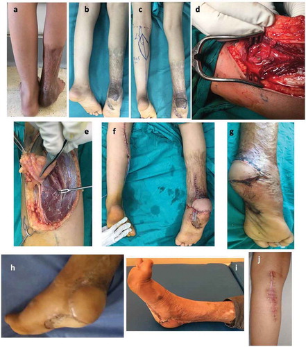 Figure 7. Case 2. a: Pre-operative photo showing the defect. b: Intraoperative photo showing the defect. c: Flap marking. d: Perforator dissection. e: Flap elevation. f: Flap insetting. g: Patient after 2 weeks. h: Patient after 2 months with good color match and thickness. i: Patient after 3 months. j: Donor side hypertrophic scar