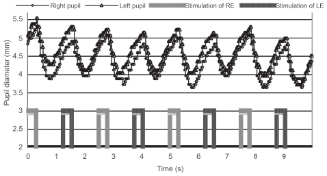 Figure 4 Pupillographic tracings of an 11-year-old boy with anisometropic and strabismic amblyopia OS. The visual acuity was 20/30 in the left eye. The contraction amplitude was slightly larger when the right eye was stimulated.