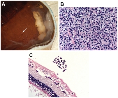 Figure 5 (A) Gross photograph of enucleated eye showing main superotemporal tumor and vitreous seeds overlying the macula (arrow). (B) The main tumor consisting of well-differentiated cells with abundant cytoplasm (hematoxylin-eosin, original magnification 400×). (C) A vitreous seed containing differentiated cells, with negative staining with Ki67 (hematoxylin-eosin, original magnification 400×).