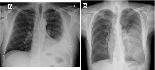 Figure 1 (A) Chest radiograph shows a left-side partially loculated pleural effusion. (B) Chest radiograph shows the D sign at the left hemithorax, indicating a laterally loculated pleural effusion.