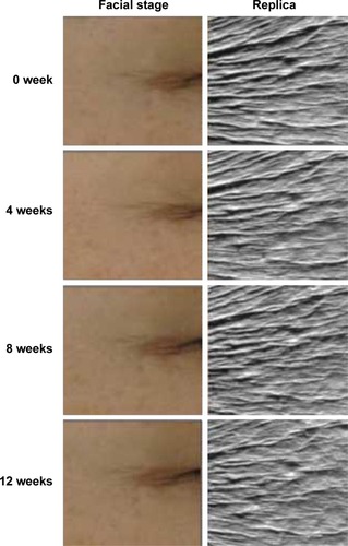 Figure 4 Representative facial images and replicas of wrinkle improvement in the crow’s feet area at baseline and after 4, 8, and 12 weeks of bee-venom serum use.