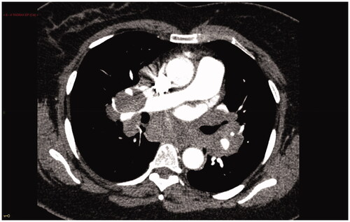 Figure 1. SAPH due to extrinsic vascular compression. CT scan shows compression of the right mediastinal pulmonary artery by enlarged lymph nodes. Note the increased diameter of main pulmonary artery as compared to aorta diameter.