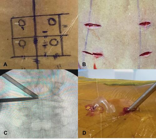 Figure 1 (A and B) Location of incision at the level of the pedicle. (C) Triangulation of working and viewing portal above the lamina. (D) Waterflow from the working portal.