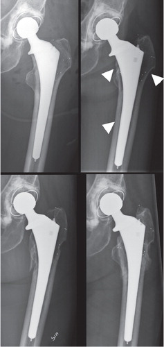 Figure 4. Example of a late-occurring periprosthetic fracture. a. Postoperatively. b. 2-year follow-up with radiographic signs of stress-shielding (arrows) including calcar atrophy and hypoattenuation of bone mass in the greater trochanter and diaphysis. At 2 years, the total decrease in BMD around the stem was –16% compared to the postoperative value. c. The periprosthetic fracture that was sustained after a low-energy trauma at 2.2 years. d. The healed fracture at 2.7 years, treated with protected weight bearing.