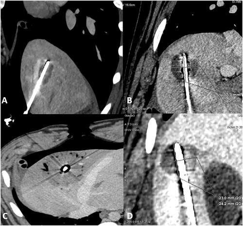 Figure 2. Liver ablation on enhanced CT scan. (A) Sagittal view of liver ablation showing the elliptical shape ablation obtained with 50 W for 5 min with a sphericity index of 0.61. (B) Fontal view of liver ablation imaging the round shape attempted with 50 W for 10 min with a sphericity index of 0.89. (C) Axial view of liver ablation obtained with 10 min 100 W with a sphericity index of 0.83. (D) Para-sagittal view showing the round shape ablation between the abdominal wall and the gallbladder obtained with 50 W for 10 min and with a sphericity index of 0.75.